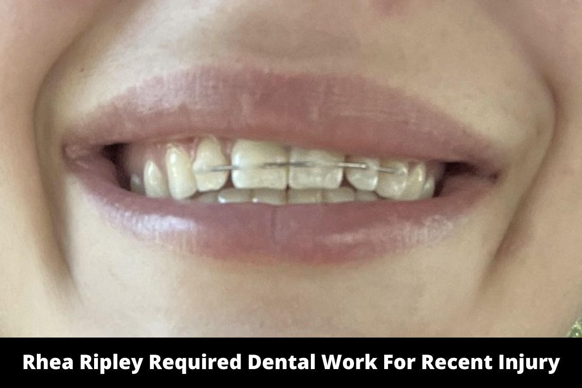 Rhea Ripley Required Dental Work For Recent Injury