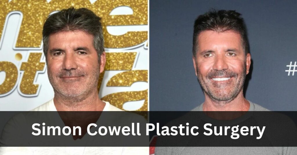 Simon Cowell Plastic Surgery
