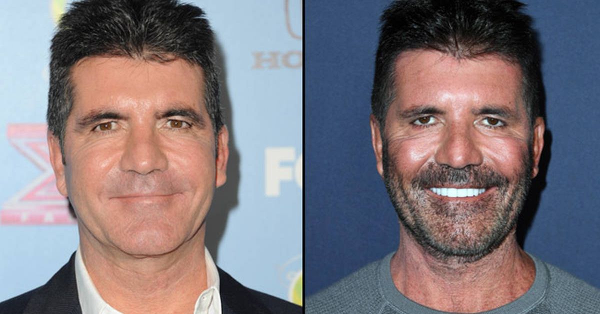 Simon Cowell Plastic Surgery