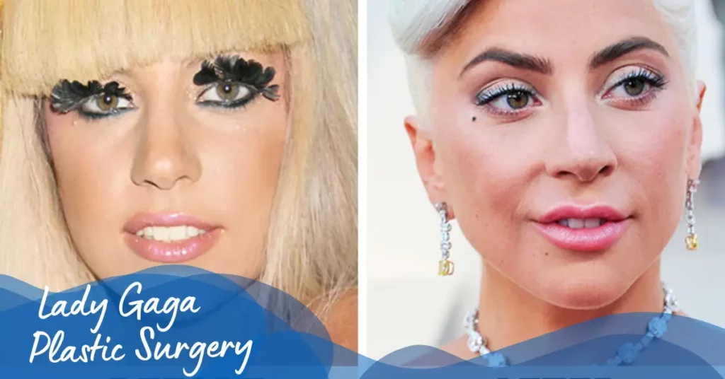 Lady Gaga Plastic Surgery