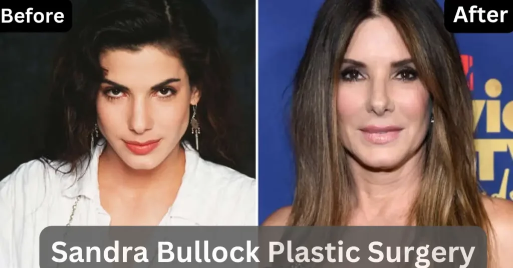 Sandra Bullock Plastic Surgery