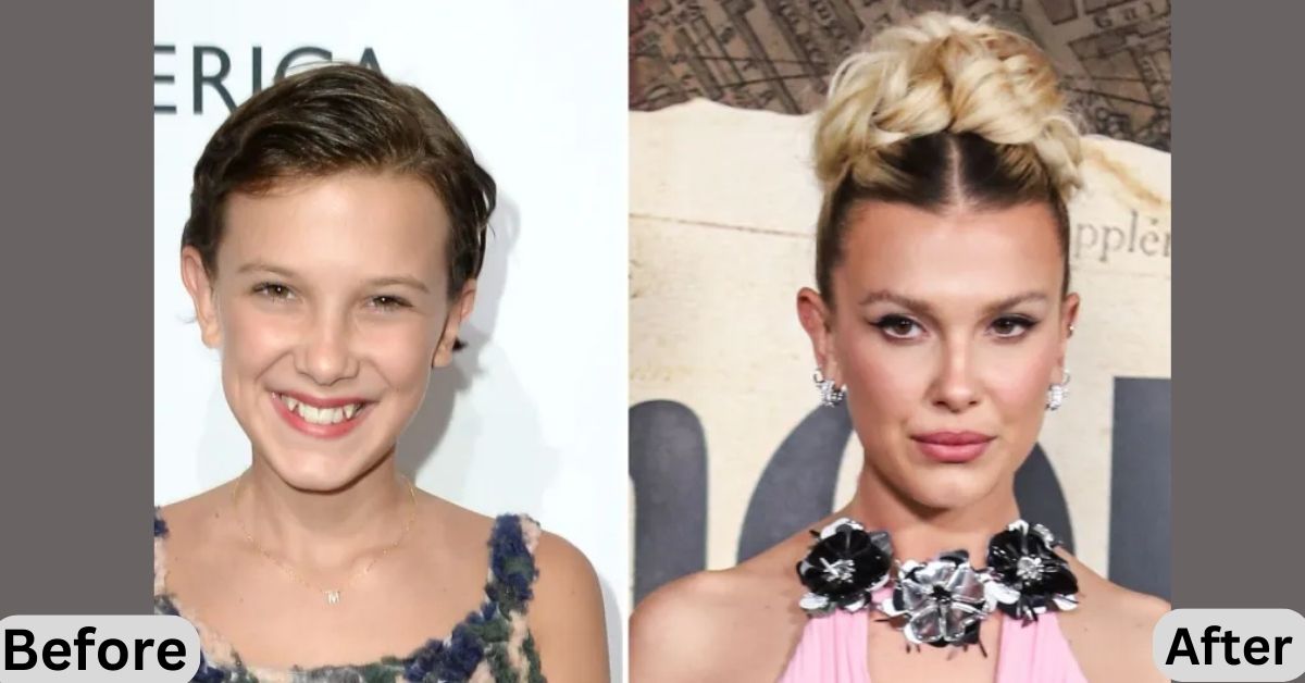 Millie Bobby Brown Plastic Surgery