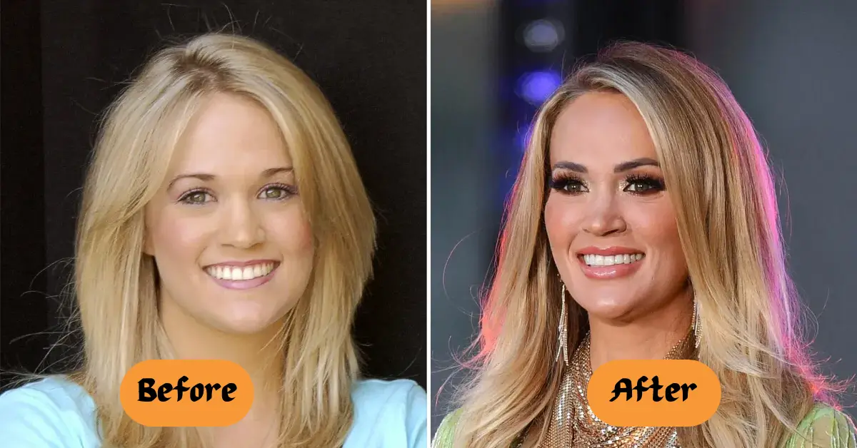 Carrie Underwood Plastic Surgery