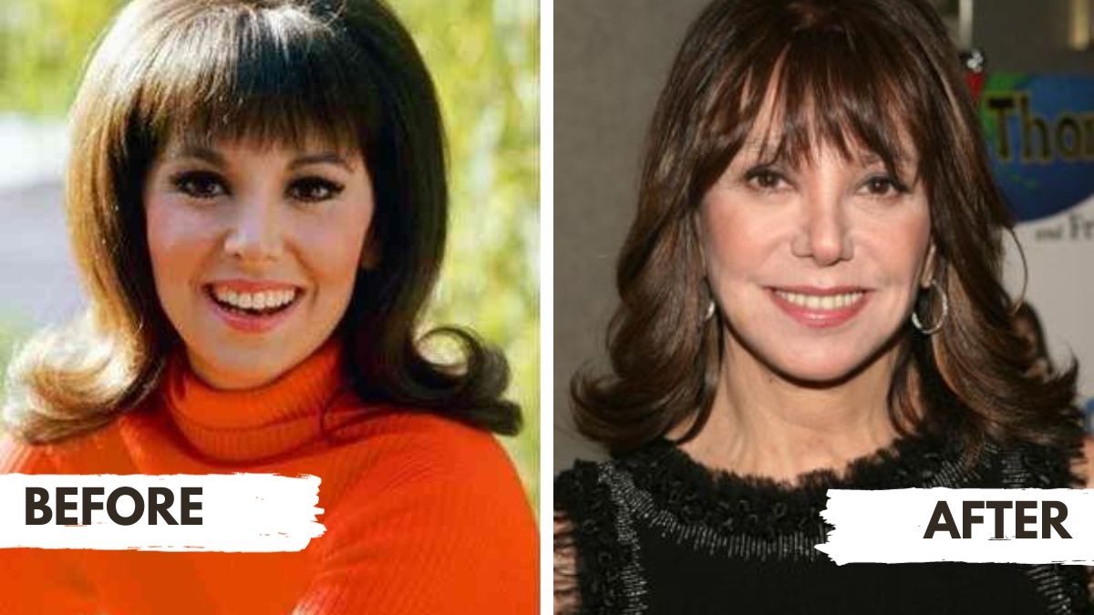 Marlo Thomas Before and After Plastic Surgery