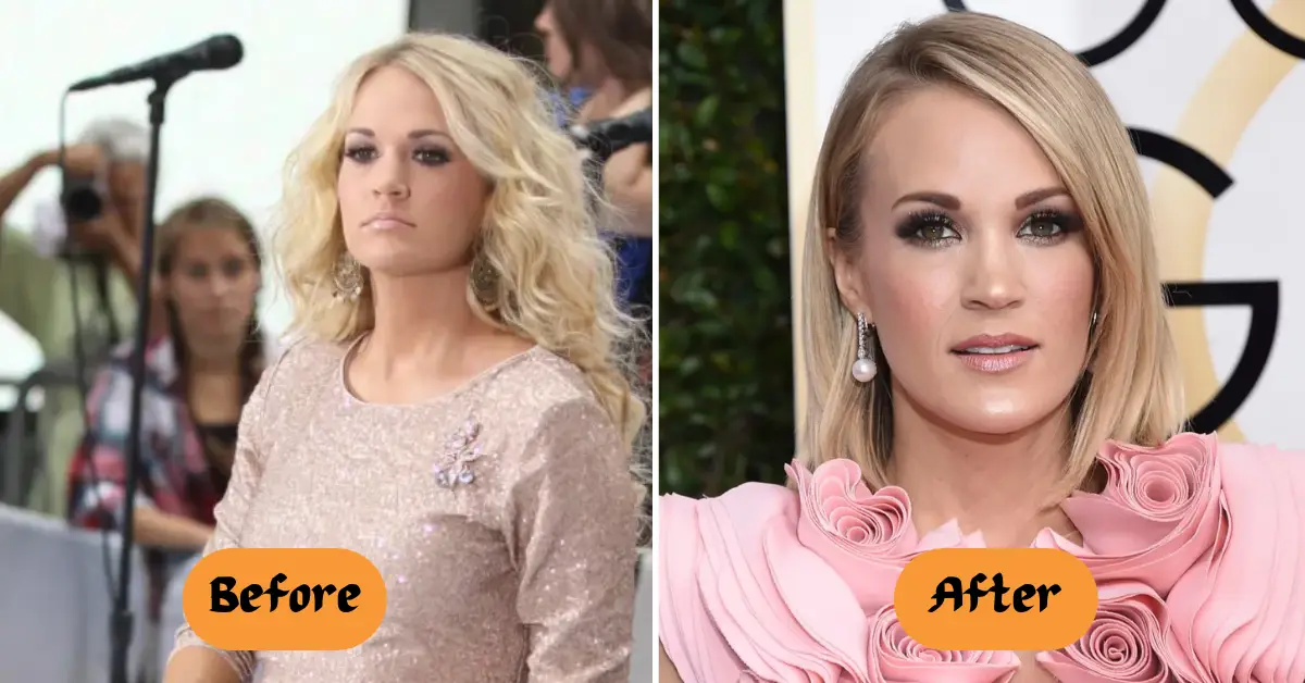 Carrie Underwood Plastic Surgery