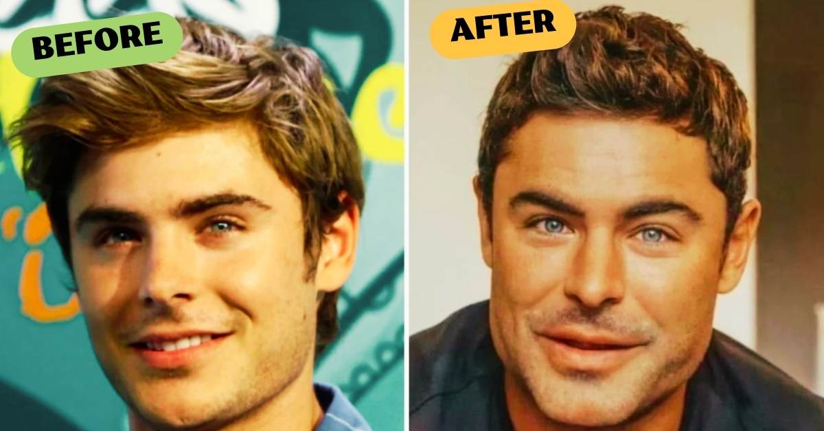 What Happened to Zac Efron's Jaw?
